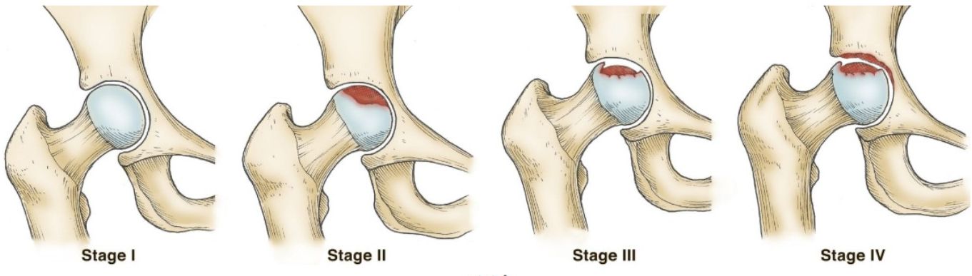 Four stages of Avascular Necrosis of the Femoral Head (Stage I–IV)