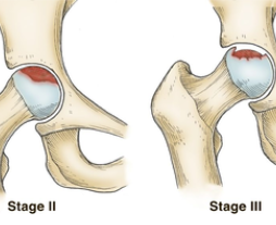 Avascular Necrosis of the Femoral Head: The Disease That Approaches Silently