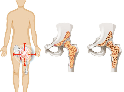 Osteoporosis and Hip Fractures: What's the Connection?