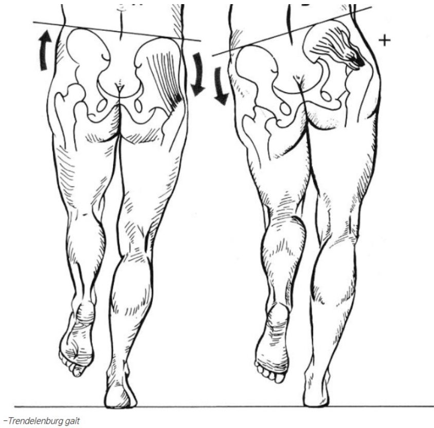Diagram of the Trendelenburg gait with arrows indicating pelvic tilt