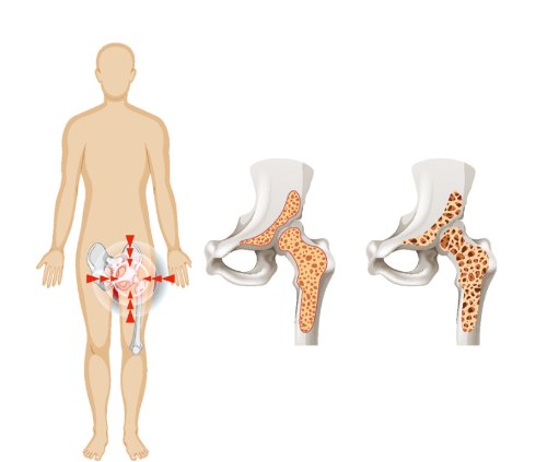 Osteoporosis hip bone density comparison