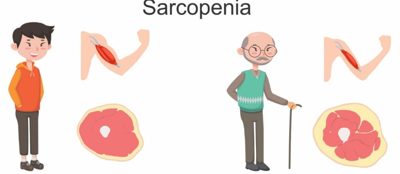 Sarcopenia — young vs older man with muscle illustration